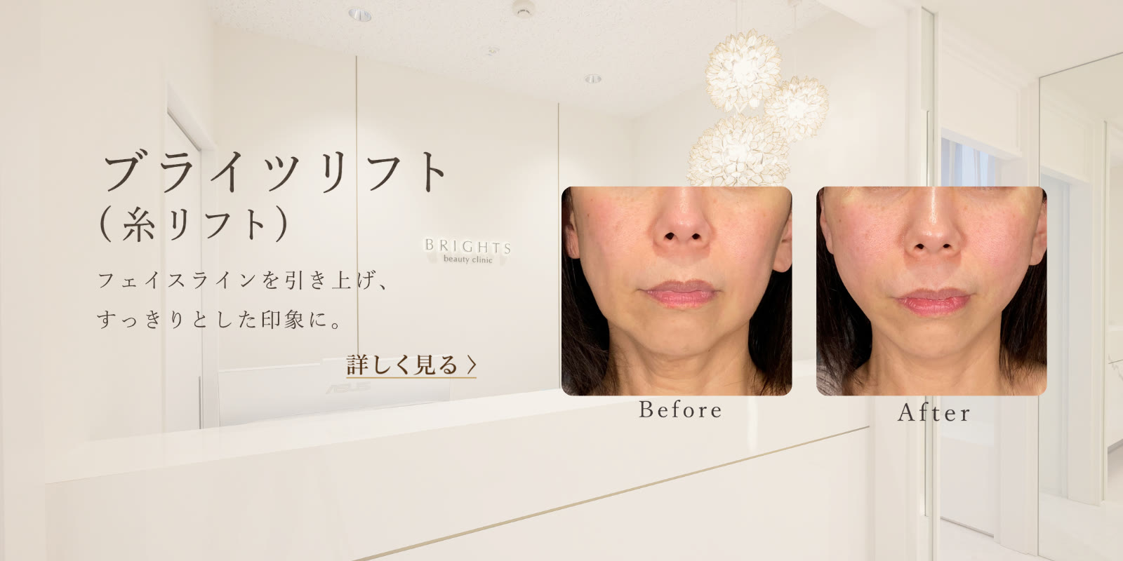 ブライツリフト 糸リフトでフェイスラインを引き上げすっきりとした印象に