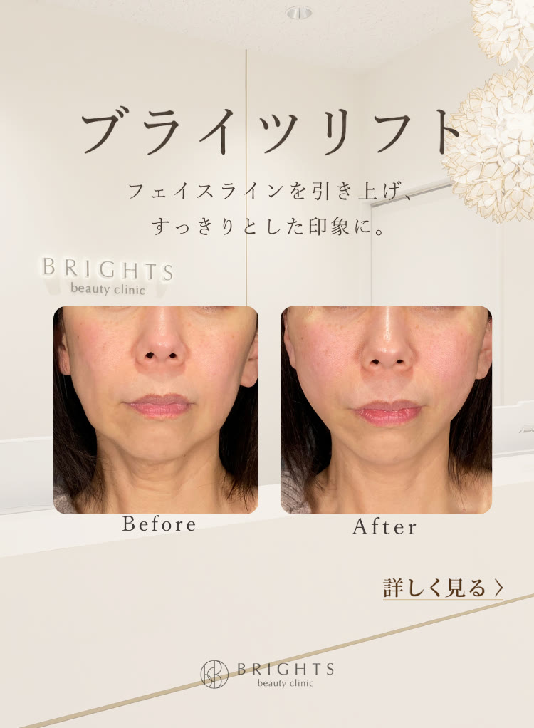ブライツリフト 糸リフトでフェイスラインを引き上げすっきりとした印象に