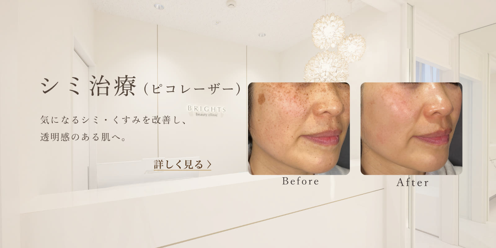シミ治療 ピコレーザーでシミ・くすみを改善し透明感のある肌へ