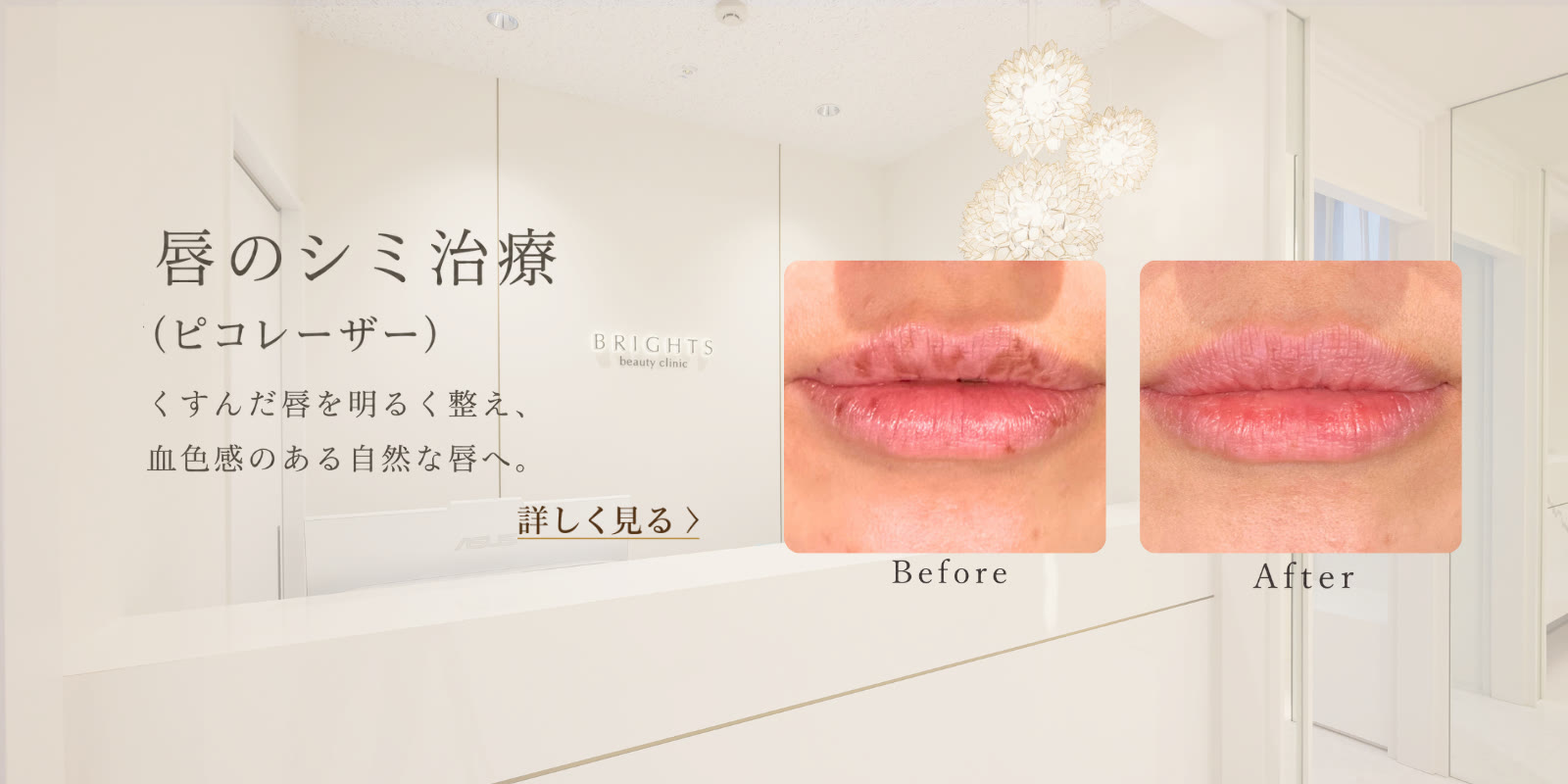 唇のシミ治療 ピコレーザーでくすんだ唇を明るく血色感のある自然な唇へ