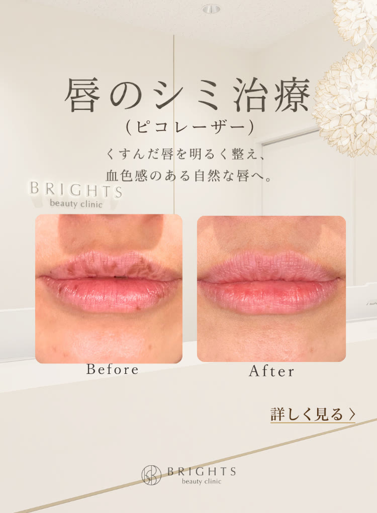 唇のシミ治療 ピコレーザーでくすんだ唇を明るく血色感のある自然な唇へ