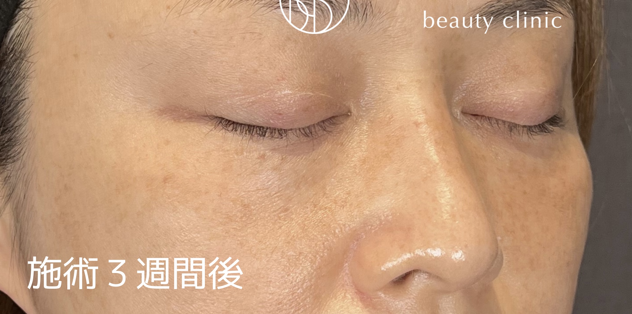 施術後