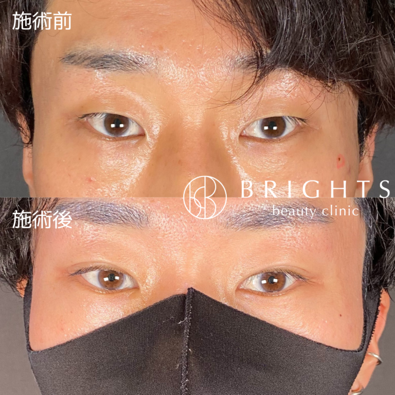 二重埋没法 術前術後 男性の目もとの変化 浦和のBRIGHTS beauty clinic