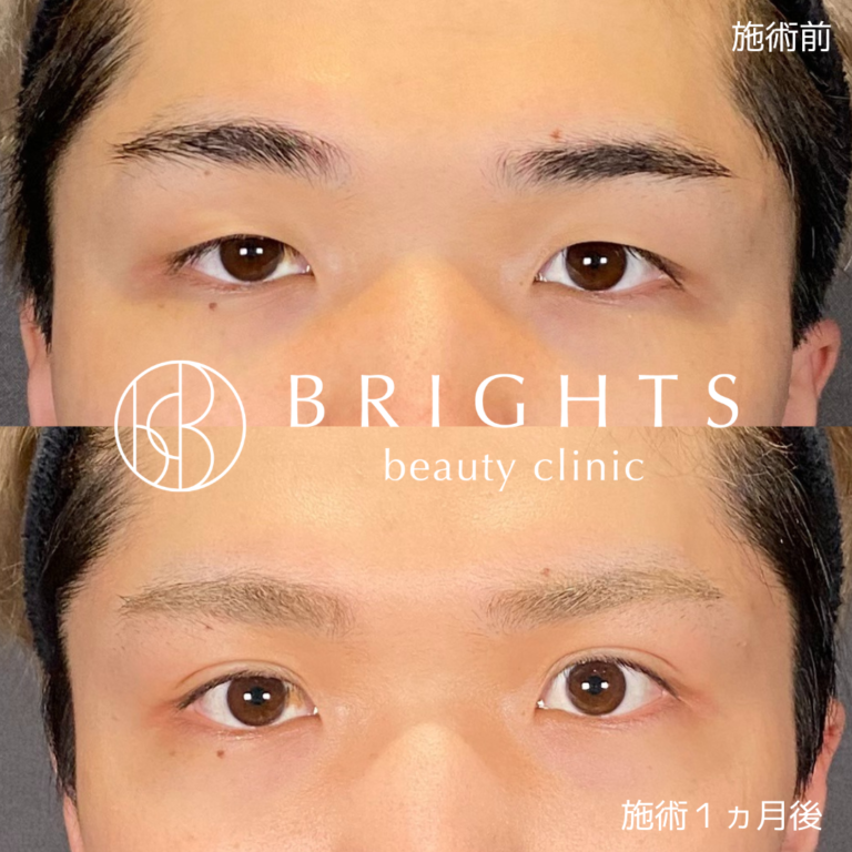 二重埋没法 術前術後 短時間の施術での変化 浦和のBRIGHTS beauty clinic