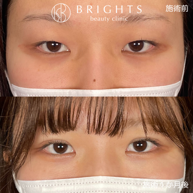 二重埋没法 術前術後 やわらかい印象の二重 浦和のBRIGHTS beauty clinic