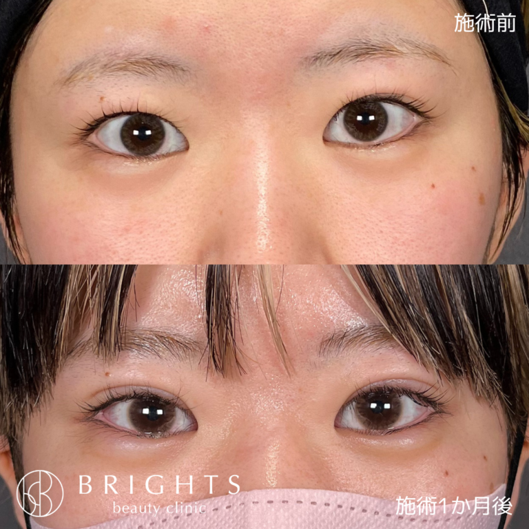 二重埋没法 術前術後 外れにくい留め方での変化 浦和のBRIGHTS beauty clinic
