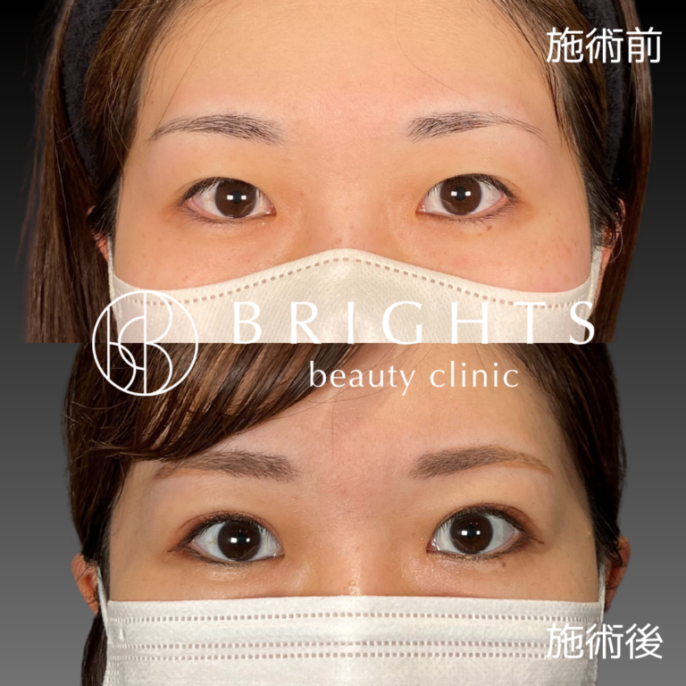 二重埋没法 術前術後 控えめな幅の二重 浦和のBRIGHTS beauty clinic