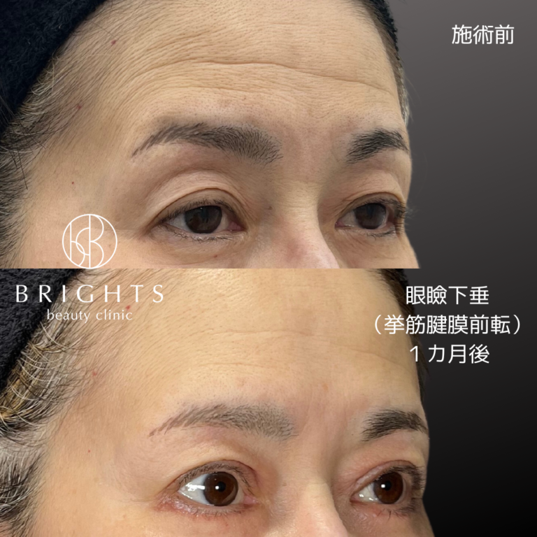 切開眼瞼下垂 挙筋腱膜前転法 術前術後 目の開きと額のしわの変化 浦和のBRIGHTS beauty clinic