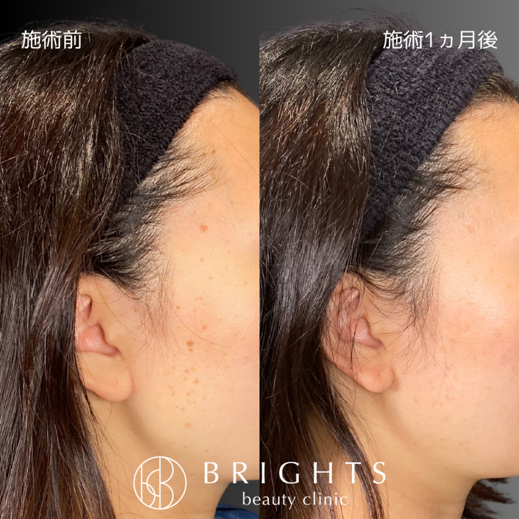 顔染みパンティ え！？シミが盛り上がってきた。これって本当にシミなの？治療法教えます - ブライツ美容クリニック