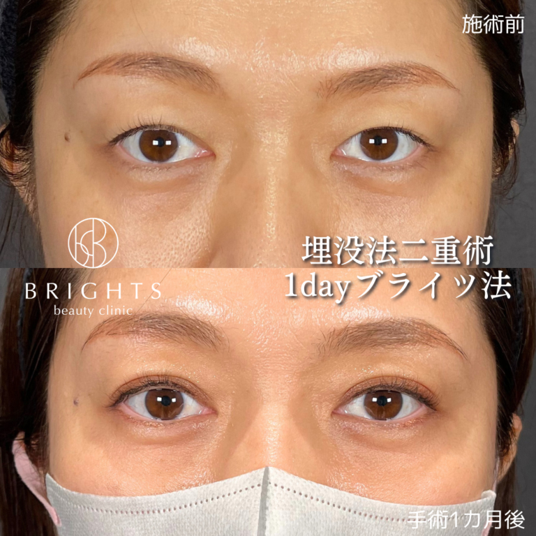 二重埋没法 術前術後 狭くなった二重幅の変化 浦和のBRIGHTS beauty clinic