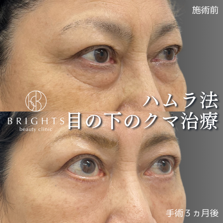 表ハムラ法 目の下のふくらみと凹みが同時に改善した症例