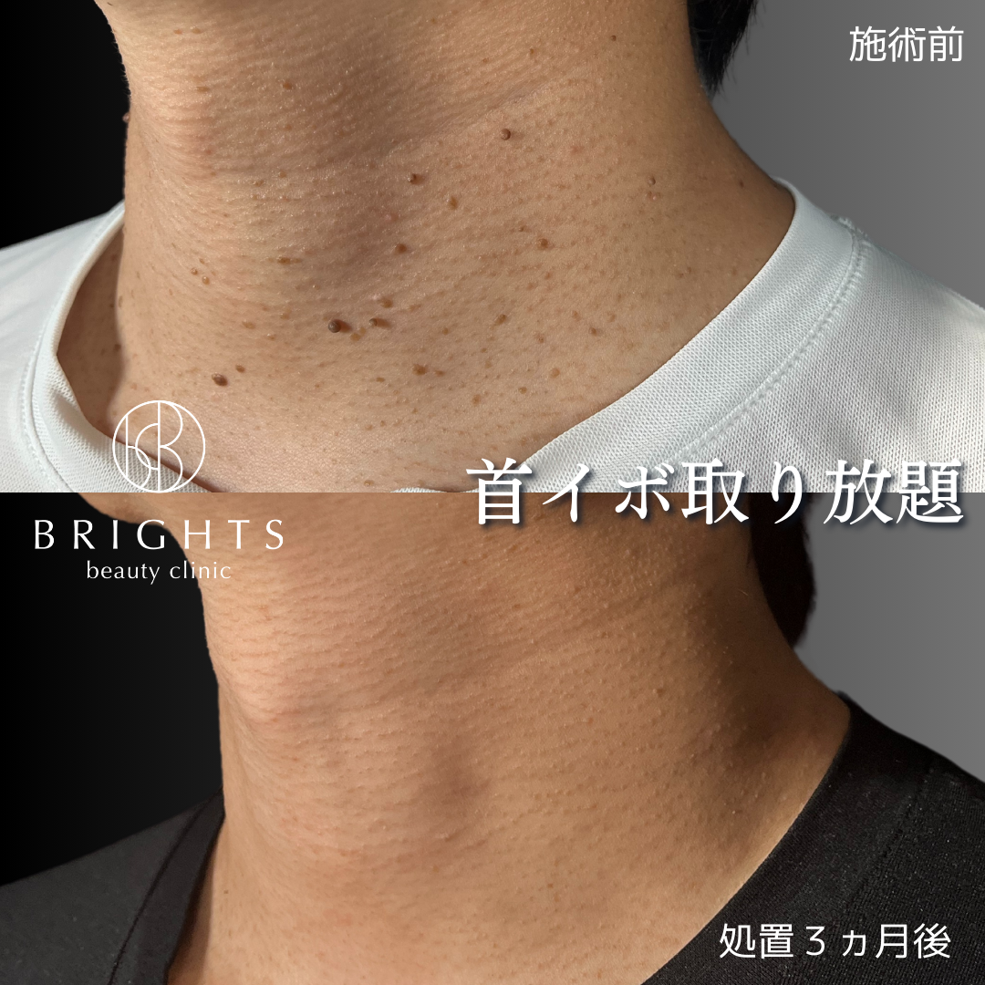 首のイボ（アクロコルドン、スキンタッグ）除去 - BRIGHTS beauty clinic 浦和駅徒歩５分 美容皮膚科