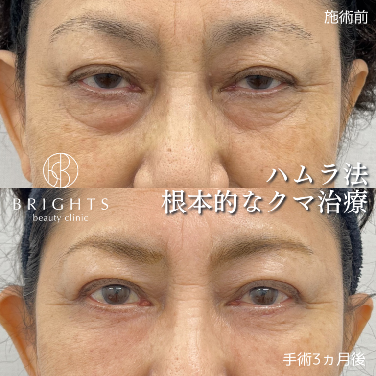 表ハムラ法 たるみの強い目の下が改善した症例