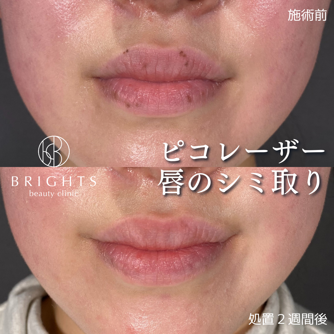リジュブネイトエキス インナーシグナル 大塚製薬のシミ対策美容液 大塚製薬スキンケア 通販