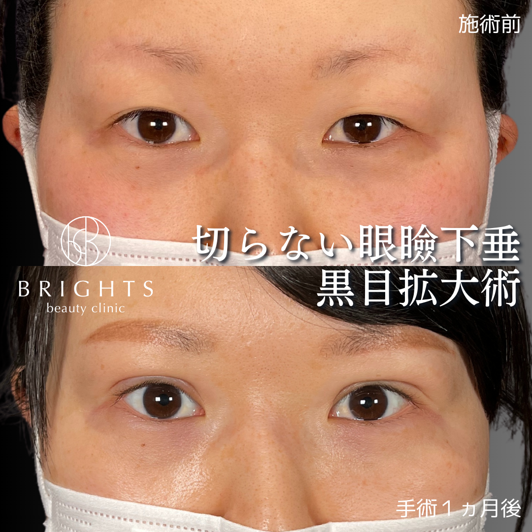 黒目拡大術で切らずに目を大きくする！ - 切らない眼瞼下垂ならBRIGHTS beauty clinic 浦和駅徒歩5分