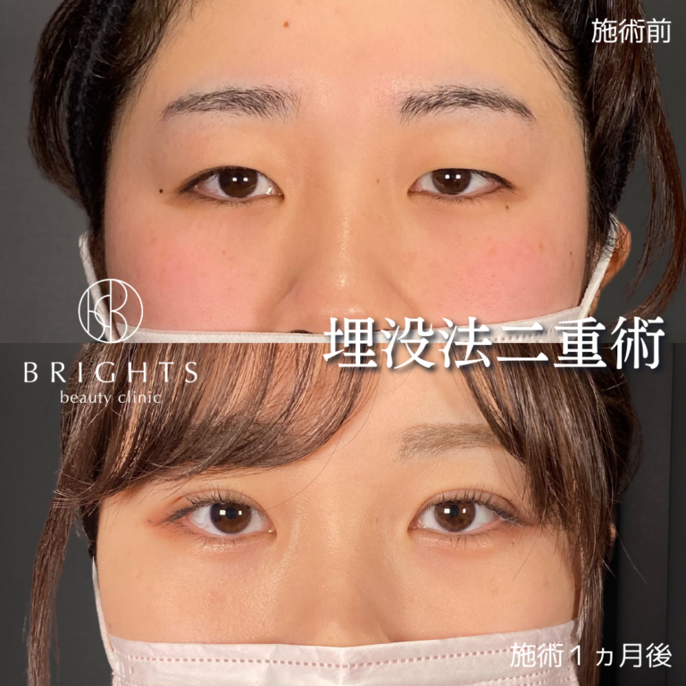 二重埋没法 術前術後 目もとがはっきりした変化 浦和のBRIGHTS beauty clinic