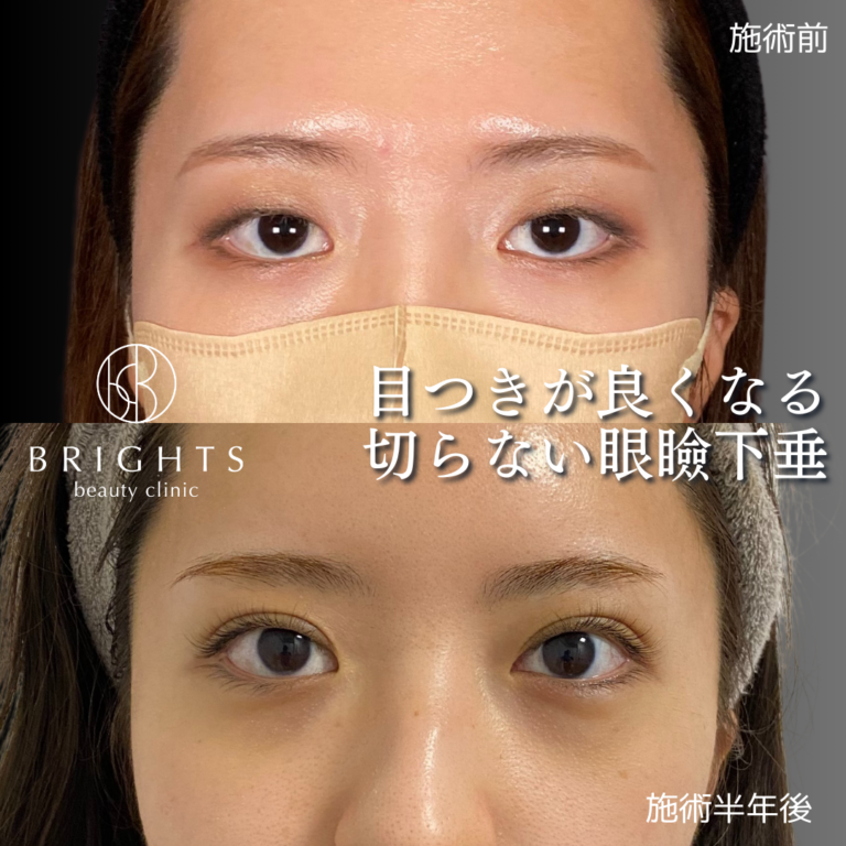 切らない眼瞼下垂 術前術後 左右差を整えながら目の開きが改善 浦和のBRIGHTS beauty clinic