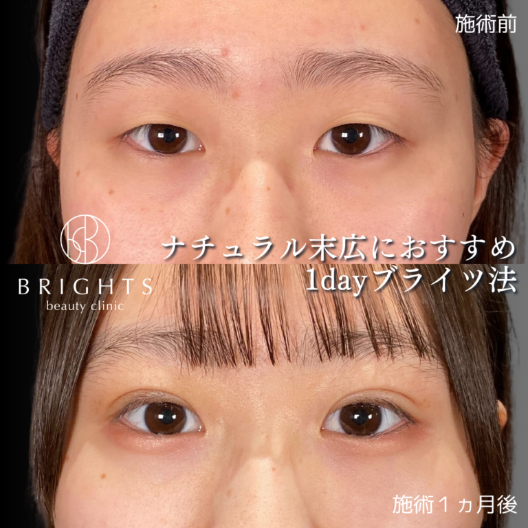 二重埋没法 術前術後 二重ラインができた変化 浦和のBRIGHTS beauty clinic