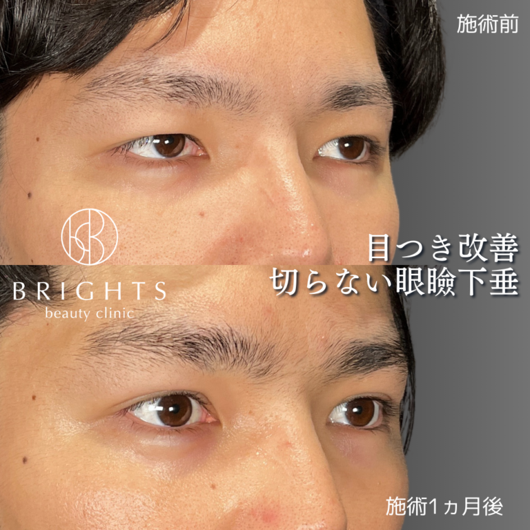 切らない眼瞼下垂 術前術後 目の開きと二重のラインが変化 浦和のBRIGHTS beauty clinic