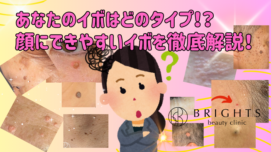 あなたのイボはどのタイプ！？顔にできやすいイボを徹底解説！
