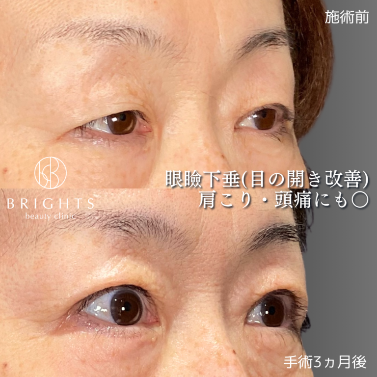 切開眼瞼下垂 挙筋腱膜前転法 術前術後 まぶたが開きやすくなった変化 浦和のBRIGHTS beauty clinic