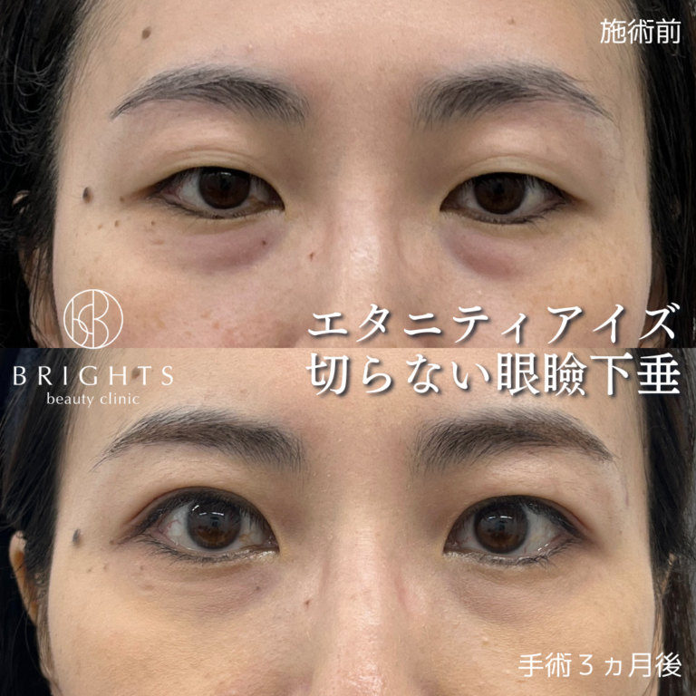 切らない眼瞼下垂 術前術後 まぶたが挙がりやすくなった変化 浦和のBRIGHTS beauty clinic
