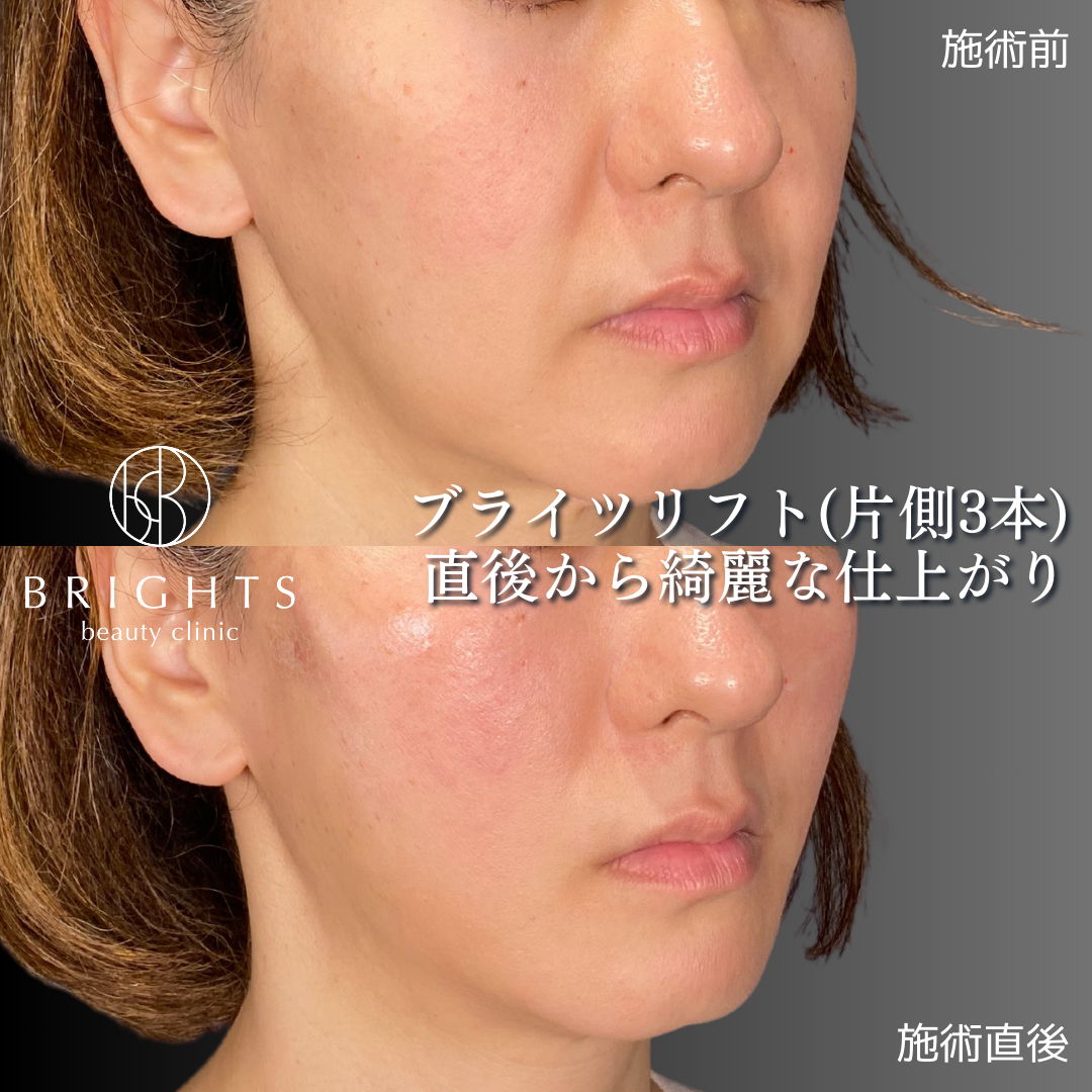 片側3本ずつのブライツリフト症例の施術前と施術直後の比較
