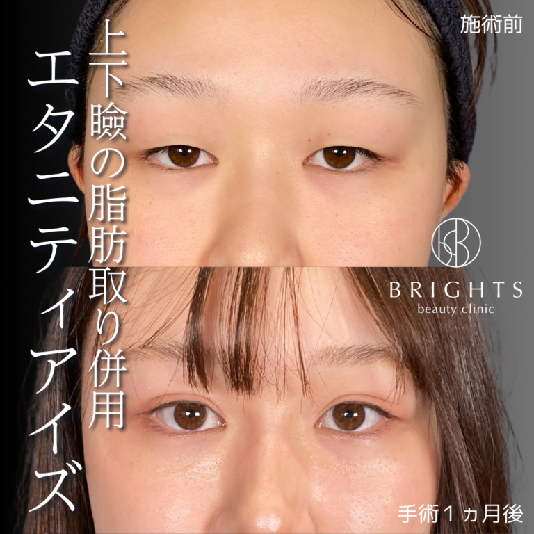 二重埋没法 術前術後 目もとの印象の変化 浦和のBRIGHTS beauty clinic