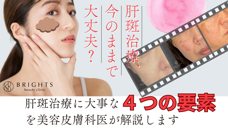 その肝斑治療で大丈夫！？肝斑治療に大事な「４要素」を美容皮膚科医が解説します