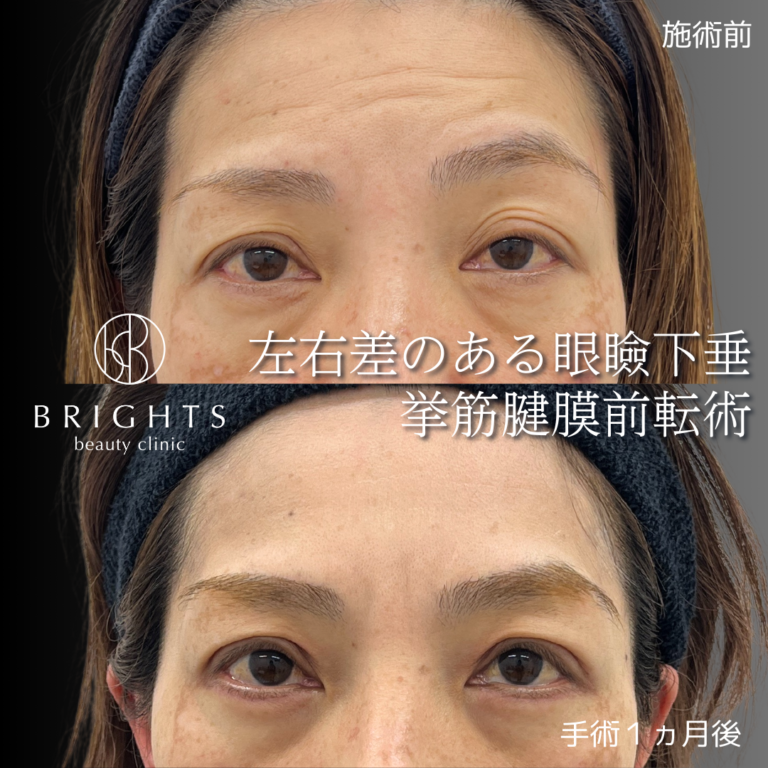 切開眼瞼下垂 挙筋腱膜前転法 術前術後 左右差のある眼瞼下垂 浦和のBRIGHTS beauty clinic