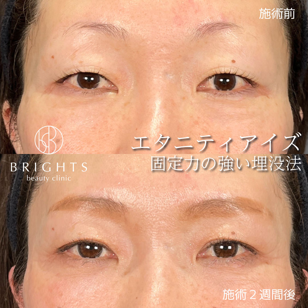 二重埋没法エタニティアイズの術前と術後2週間の目元写真（症例44）｜BRIGHTS beauty clinic
