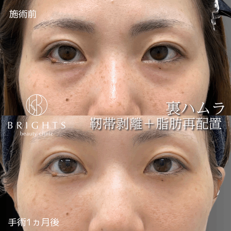 裏ハムラ法 脂肪注入なしでハの字型の目の下のクマが改善した症例