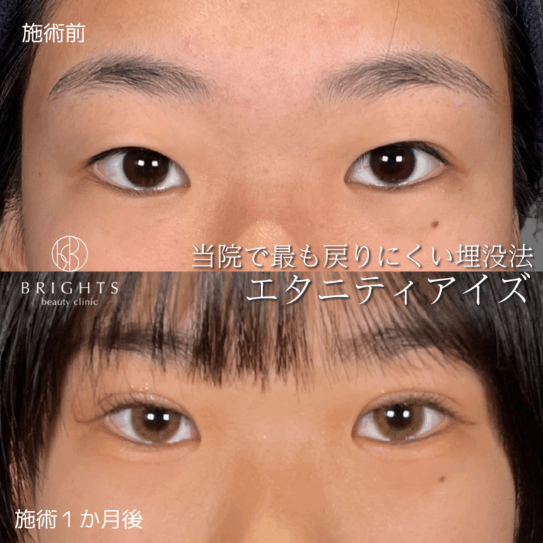 二重埋没法 術前術後 目もとの変化 浦和のBRIGHTS beauty clinic