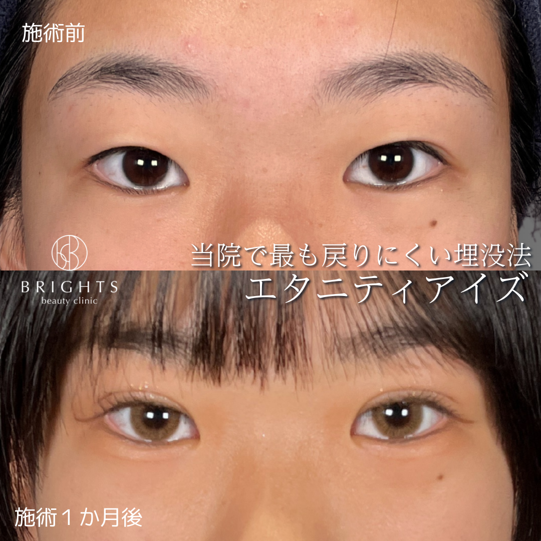 二重埋没法エタニティアイズの術前と術後1か月の目元写真（症例47）｜BRIGHTS beauty clinic