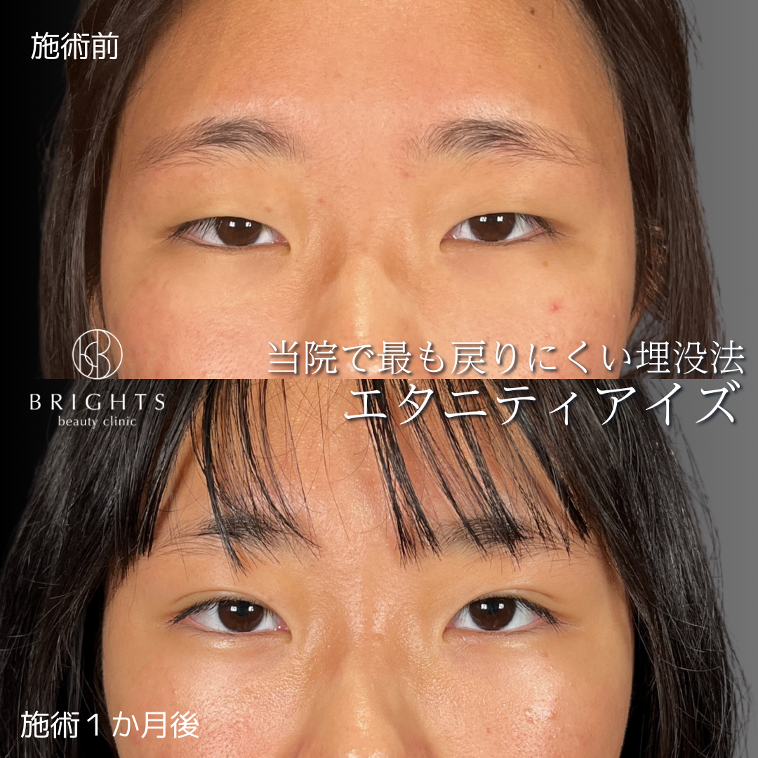 二重埋没法エタニティアイズの術前と術後1か月の目元写真（症例46）｜BRIGHTS beauty clinic