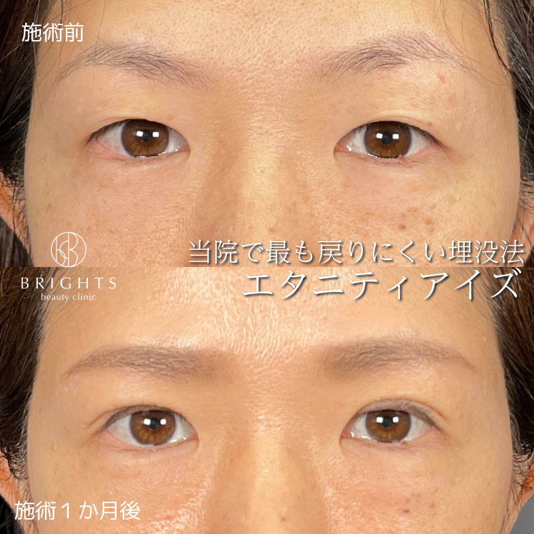 二重埋没法エタニティアイズの術前と術後1か月の目元写真（症例48）｜BRIGHTS beauty clinic