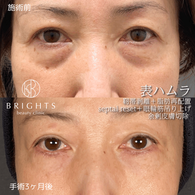 表ハムラ法 目の下のふくらみとたるみが改善しクマが目立たなくなった症例