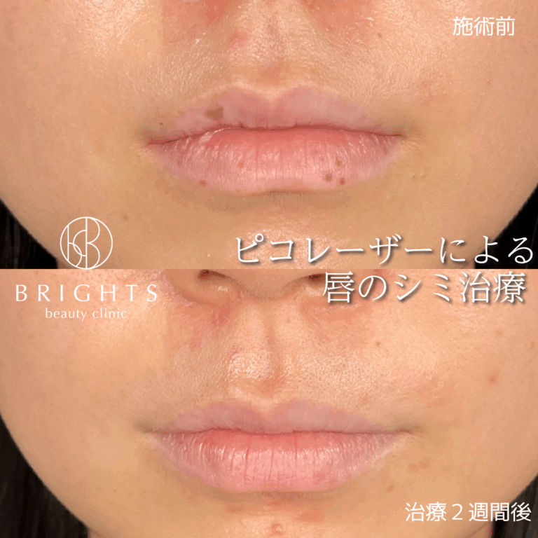 唇のシミ取り ピコスポット 施術前と治療2週間後 口元の色ムラが改善した症例写真 さいたま市浦和区