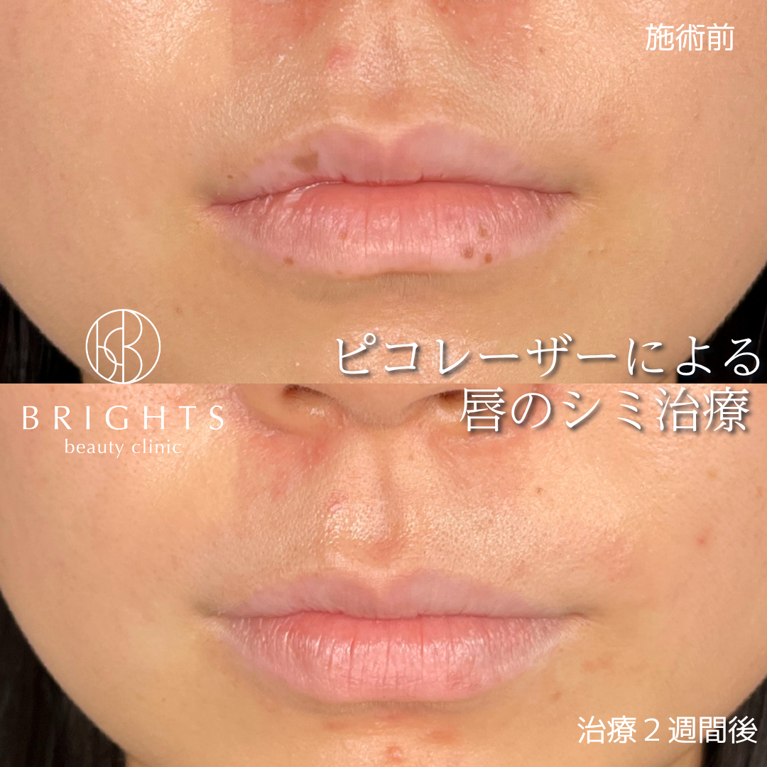 唇のシミ取り ピコスポット 施術前と治療2週間後 口元の色ムラが改善した症例写真 さいたま市浦和区