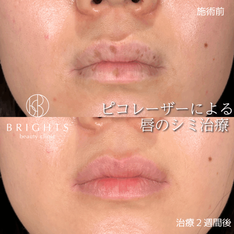 唇のシミ取り 上口唇の点状色素斑 施術前と治療2週間後の経過 浦和駅徒歩5分の美容外科の症例写真