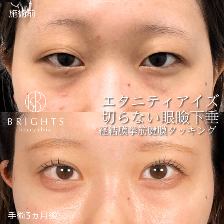切らない眼瞼下垂 経結膜的挙筋腱膜タッキング法 術前術後 浦和のBRIGHTS beauty clinic