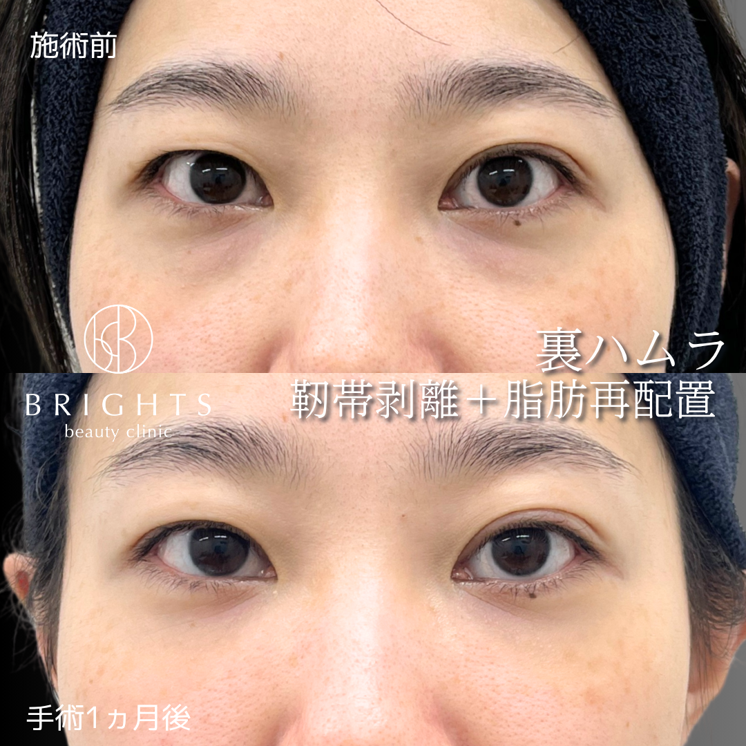 施術前・施術後