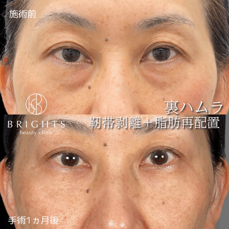裏ハムラ法 脂肪注入を併用せず目の下のふくらみと凹みが改善した症例