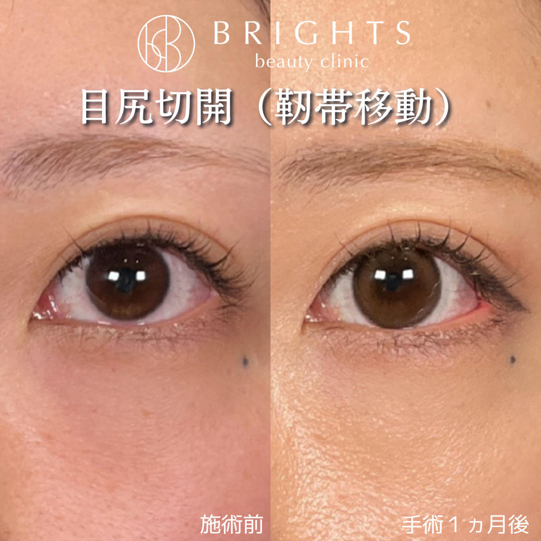 施術前・施術後