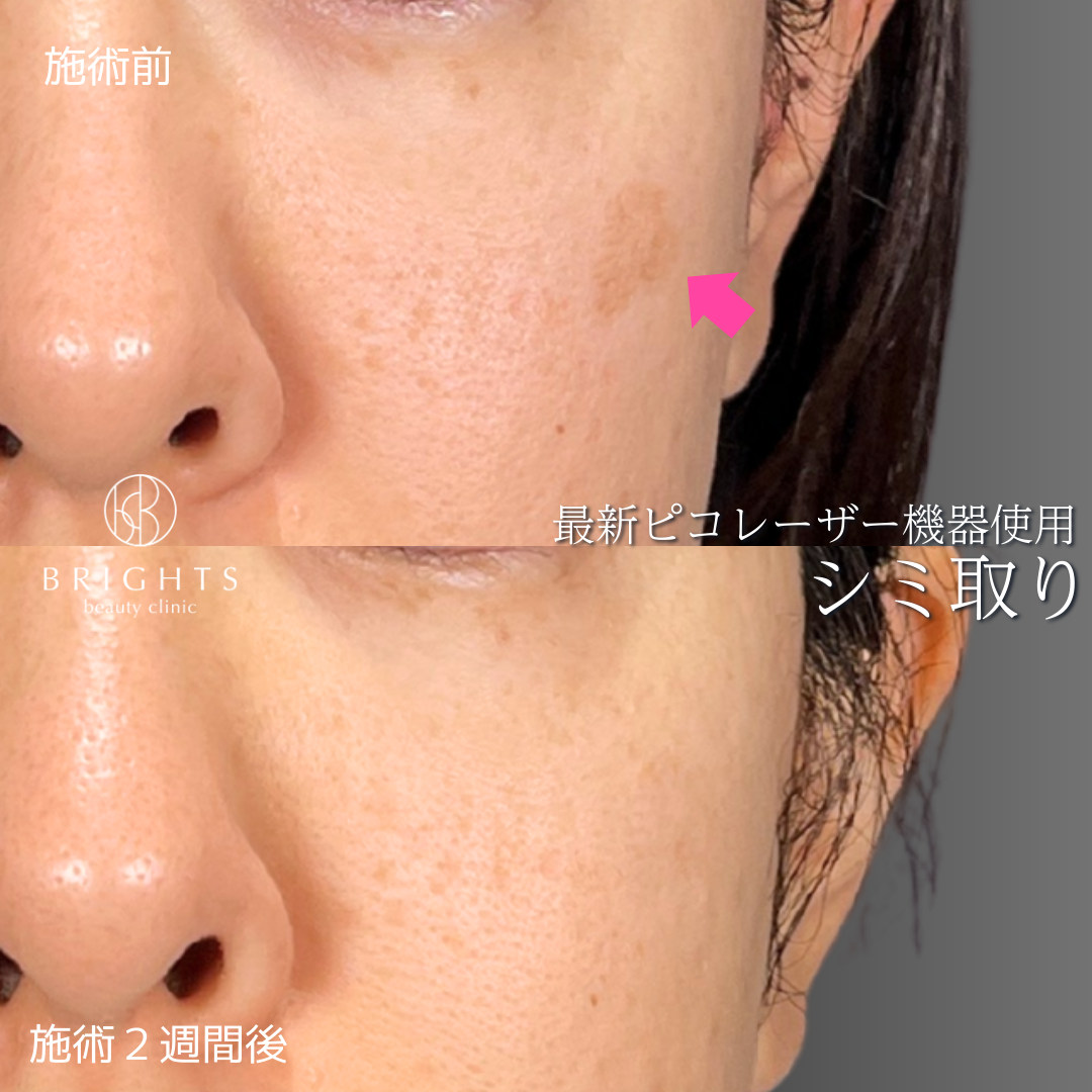 施術前・施術後