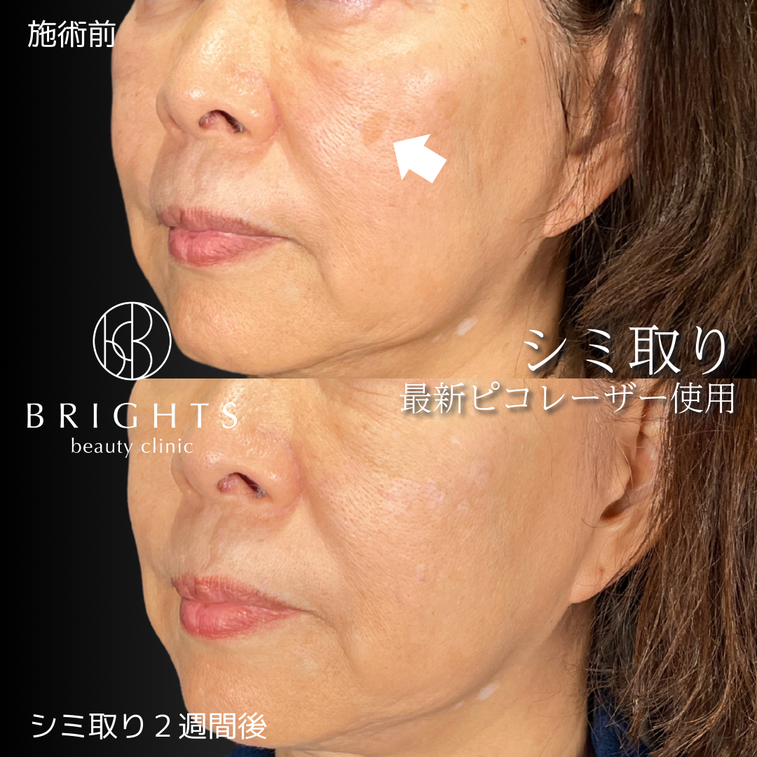 施術前・施術後