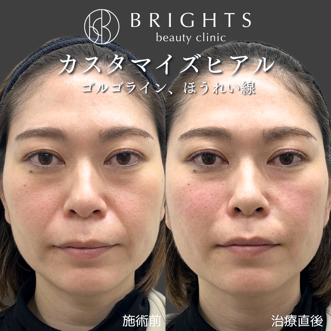 施術前・施術後