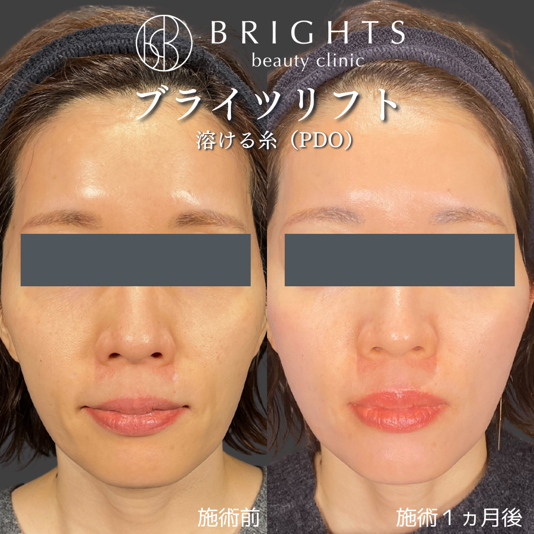 施術前・施術後