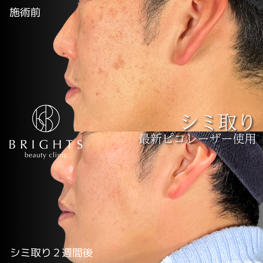 施術前・施術後