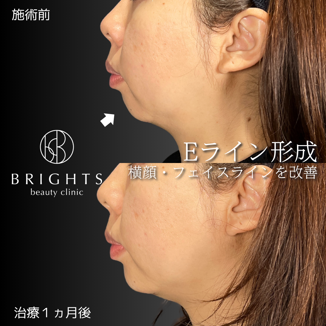 施術前・施術後